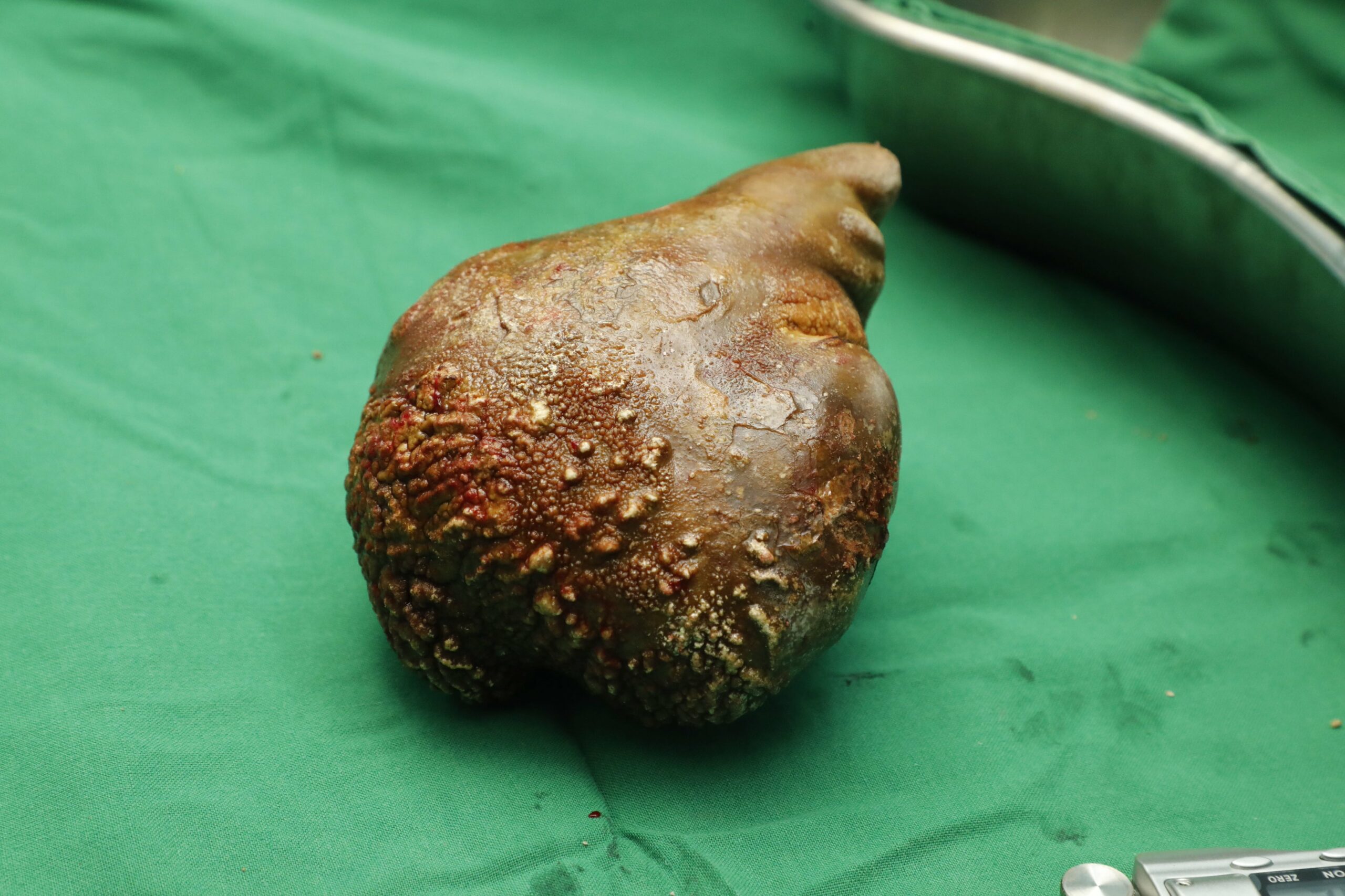 Kidney stone removed in Sri Lanka